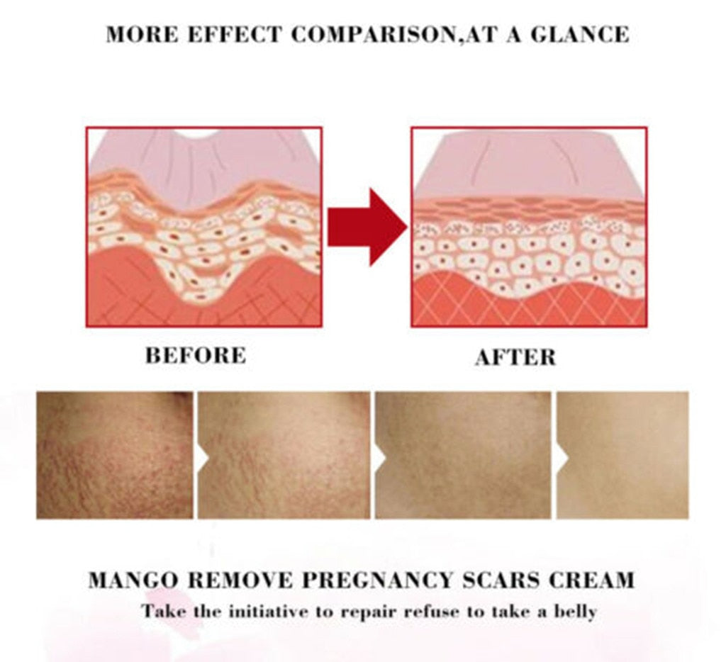 EFERO Repair Cream Removal Scar Stretch Marks  Treatment  Postpartum Maternity Skin Solution Body Creams